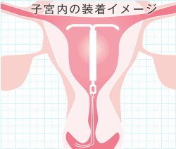 子宮内のミレーナ装着イメージ